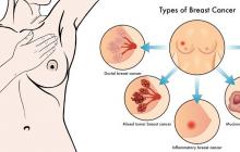 Kā noteikt krūts vēzi sievietēm: simptomi un cēloņi